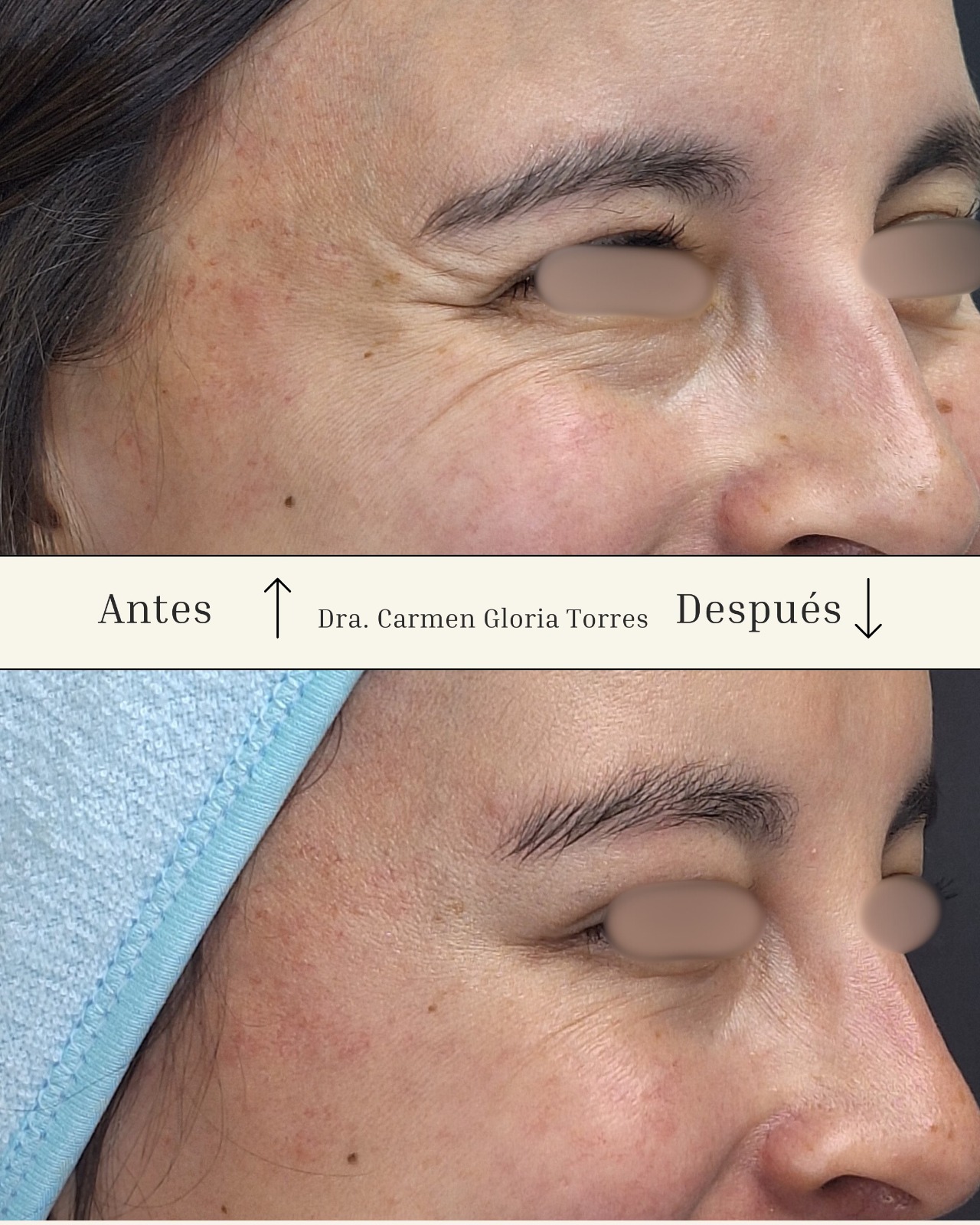 Antes y después de armonización orofacial integral en Arica — Dra. Carmen Gloria Torres
