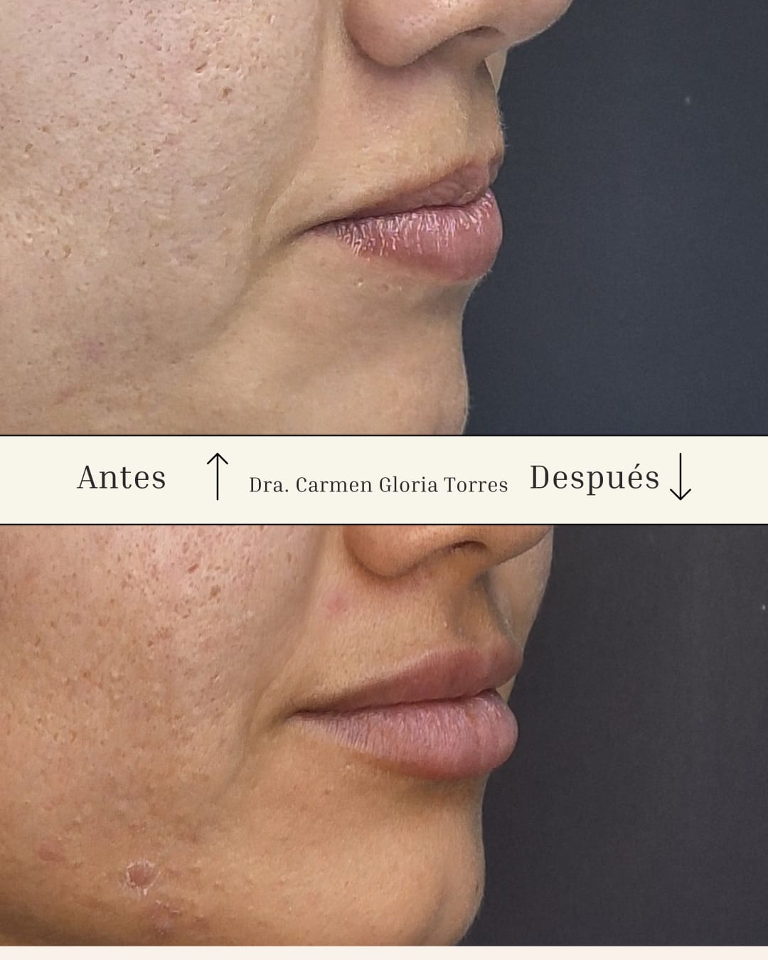 Antes y después de relleno de labios con ácido hialurónico en Arica — Dra. Carmen Gloria Torres