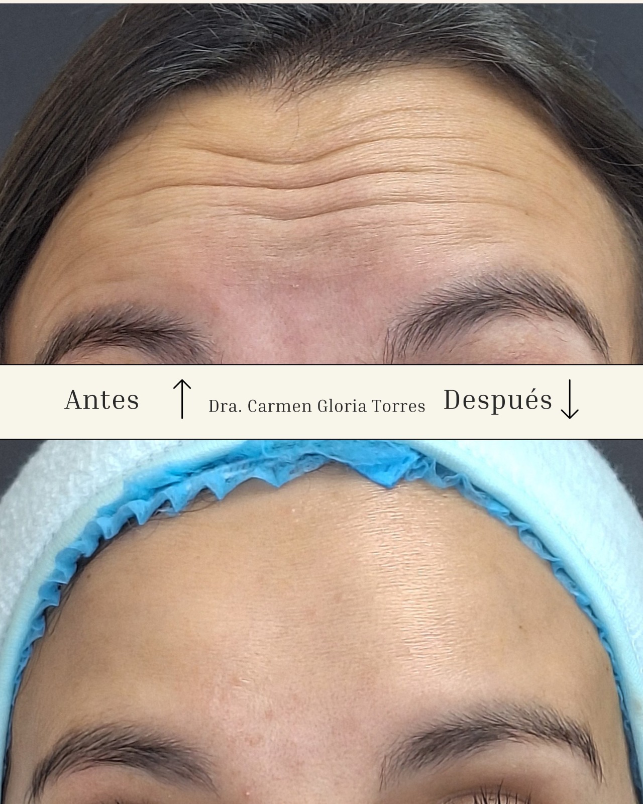 Antes y después de toxina botulínica en frente — Dra. Carmen Gloria Torres Arica